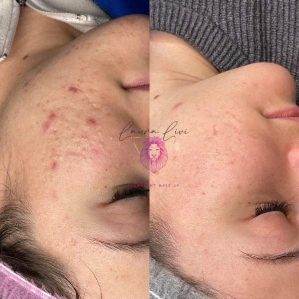 Needling
